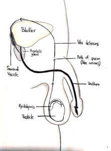 Kallman Syndrome